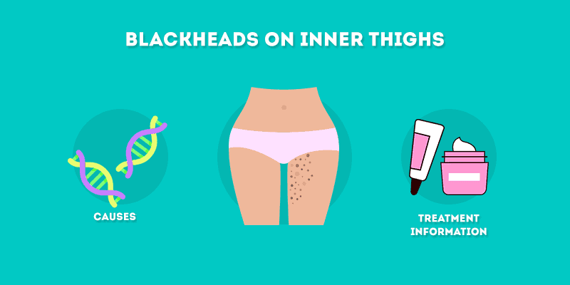 Blackheads on Inner Thighs Causes and Treatment Information