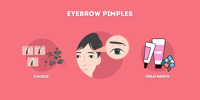 Eyebrow Pimples - Causes and Treatments