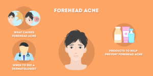 How to Get Rid of Forehead Acne