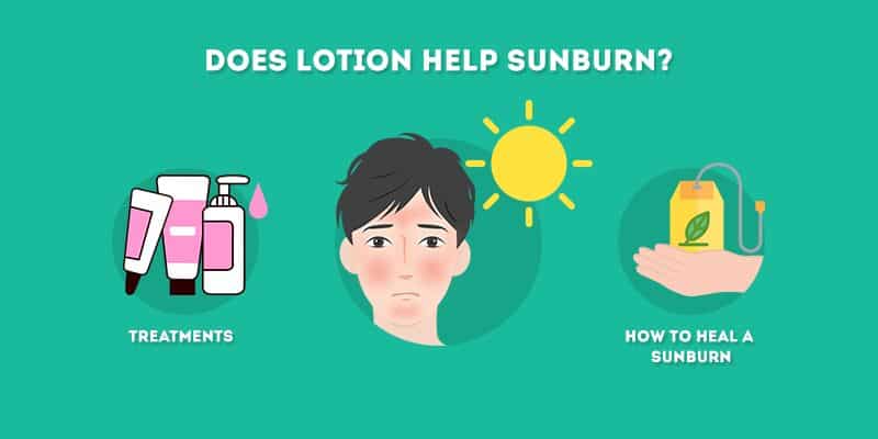 does lotion help sunburn