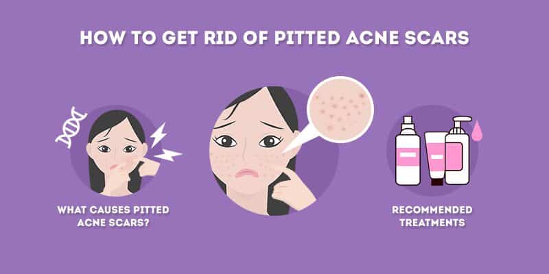 how to get rid of pitted acne scars