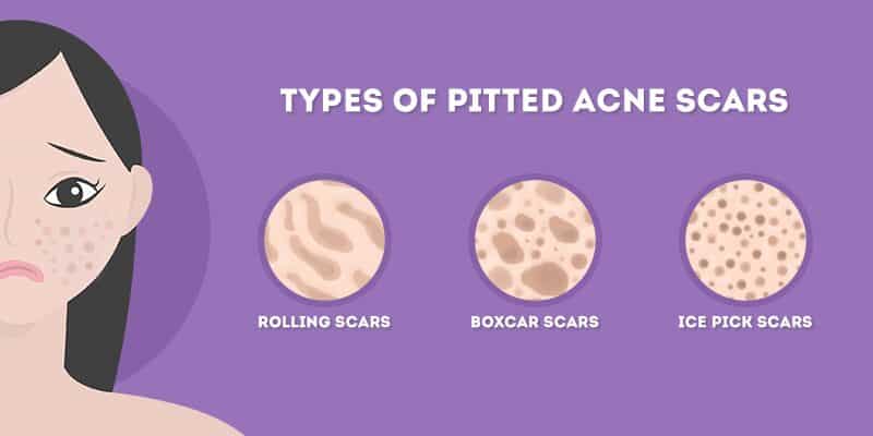 types of pitted acne scars