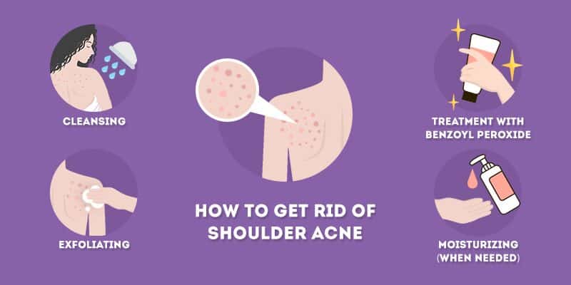 how to get rid of shoulder acne, blackheads, and pimples