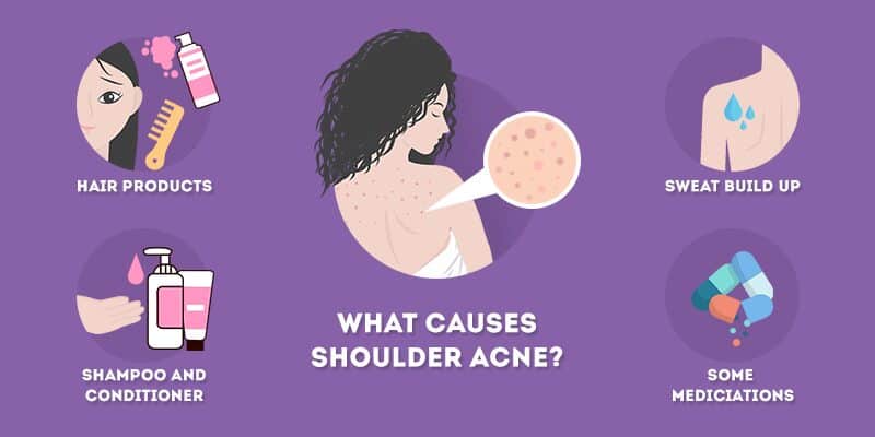 what causes shoulder acne, blackheads and pimples?