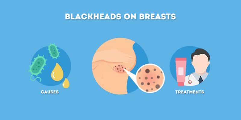 Blackheads on Breasts: Causes and Treatments