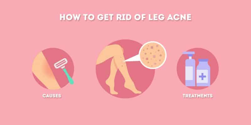 How to Get Rid of Leg Acne (Blackheads and Pimples)