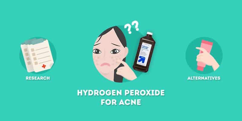 Hydrogen Peroxide for Acne