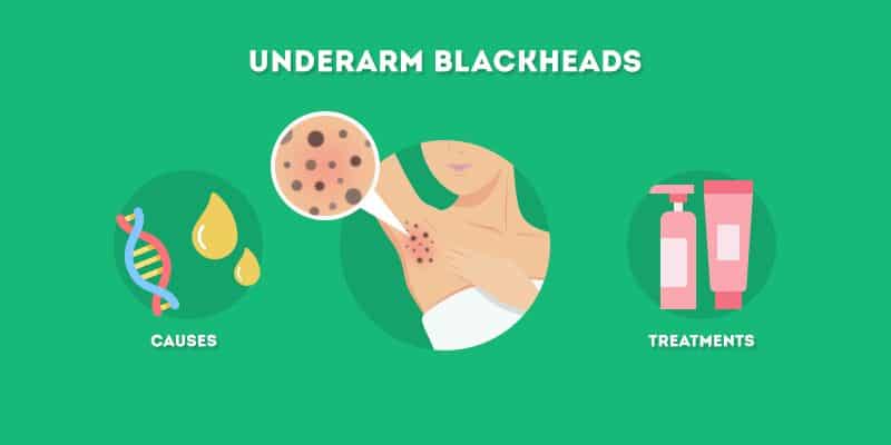 Underarm Blackheads: Causes and Treatments - Skincare Hero