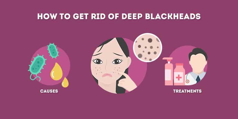 How to Get Rid of Deep Blackheads (At Home)