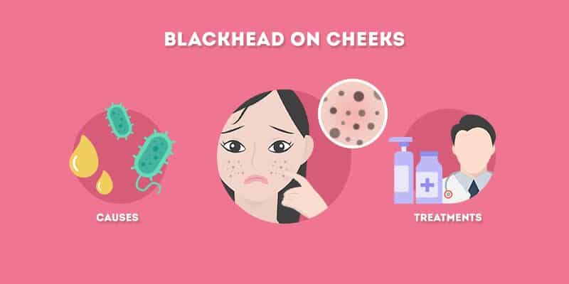blackhead on cheeks: causes and treatments