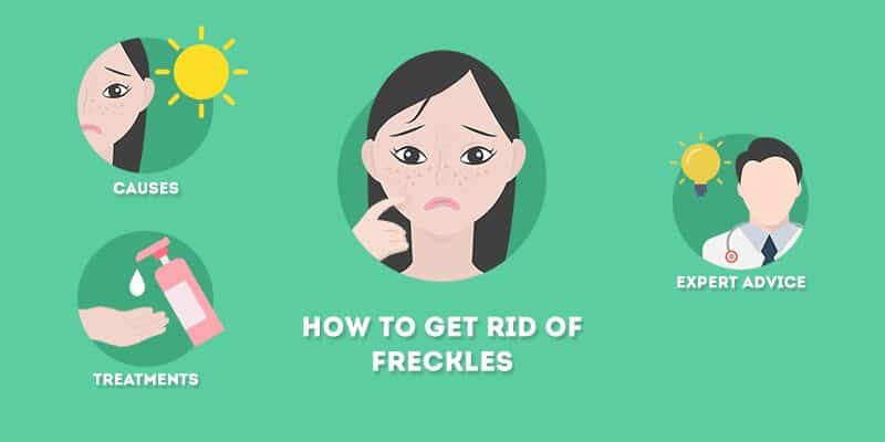 How to Get Rid of Freckles (Permanently)